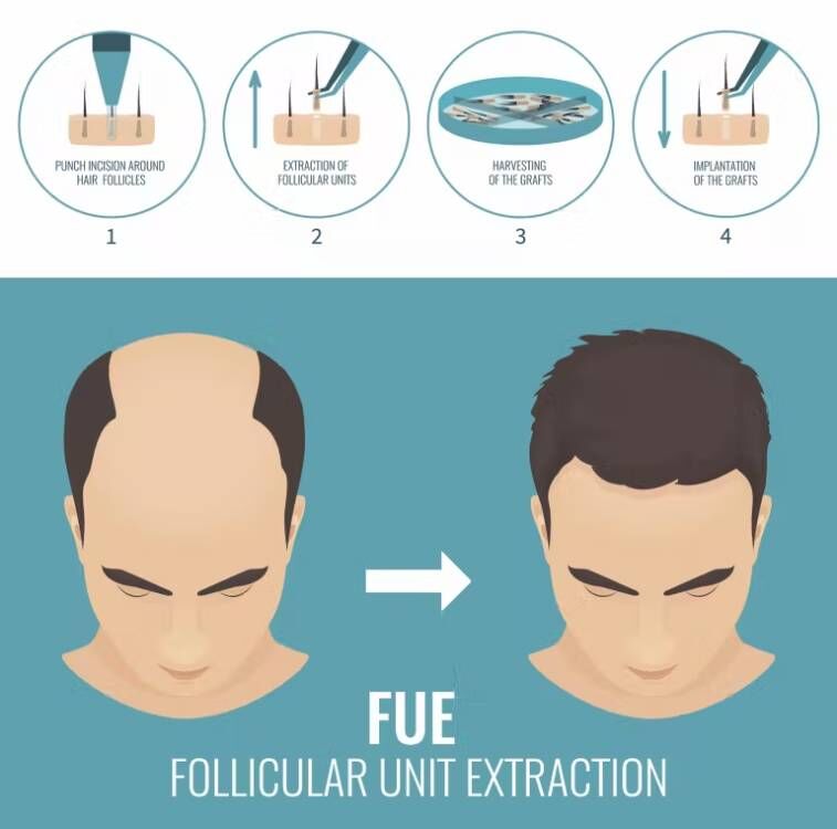 FUE-máquina de Trasplante de C - Hair Care Nutrition reseña y precio